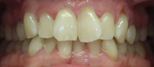Teath Before