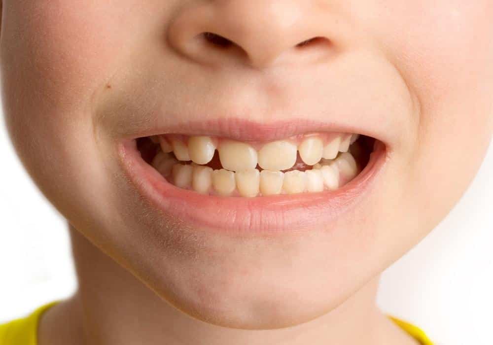 Malocclusions
