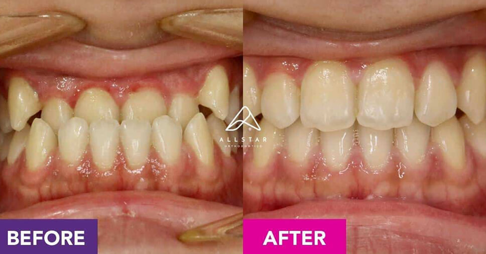 teeth