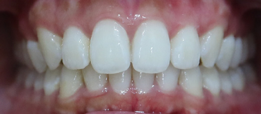 Teath After