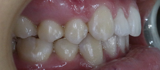 Teath After