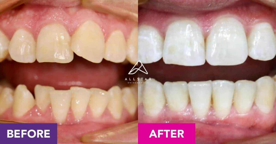 teeth