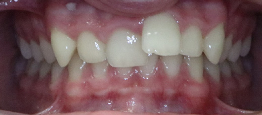 Teath Before