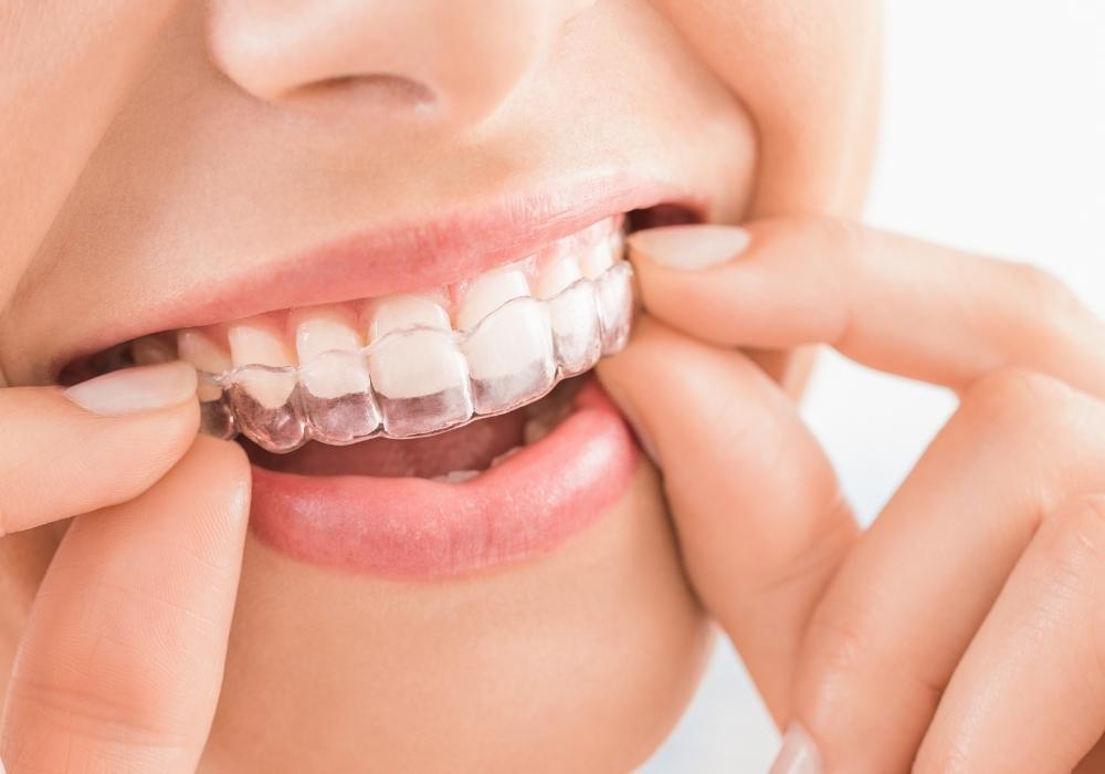 Invisalign and Clear Aligner Cost