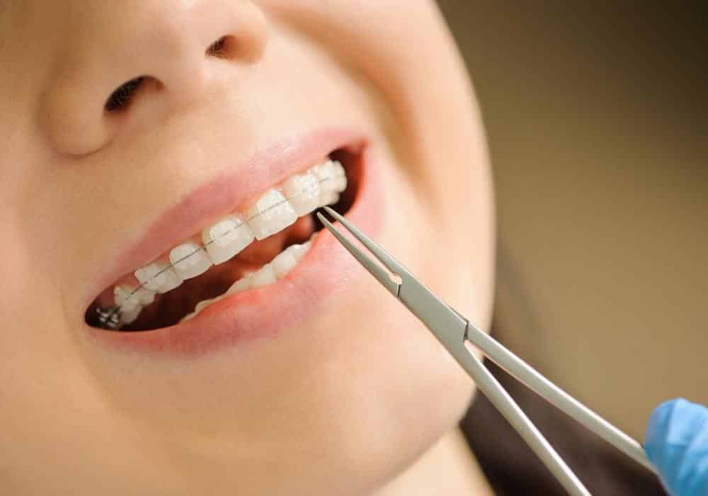 Braces, New Developments