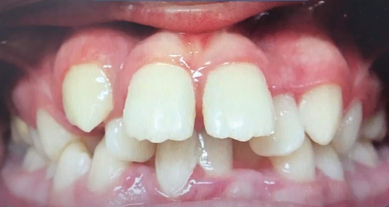 Common Questions About Clear Aligners