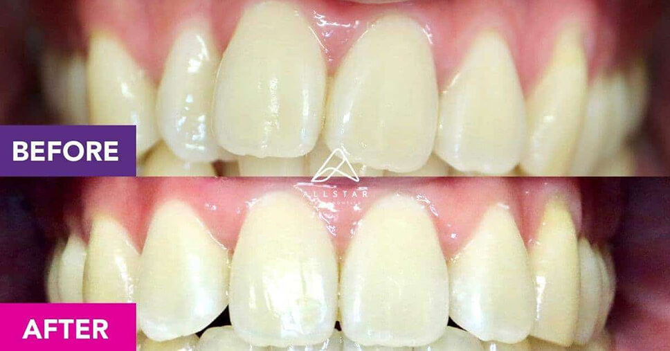 teeth