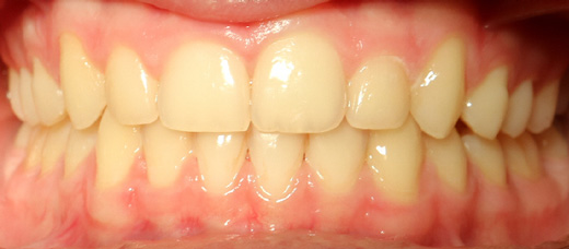 Teath After