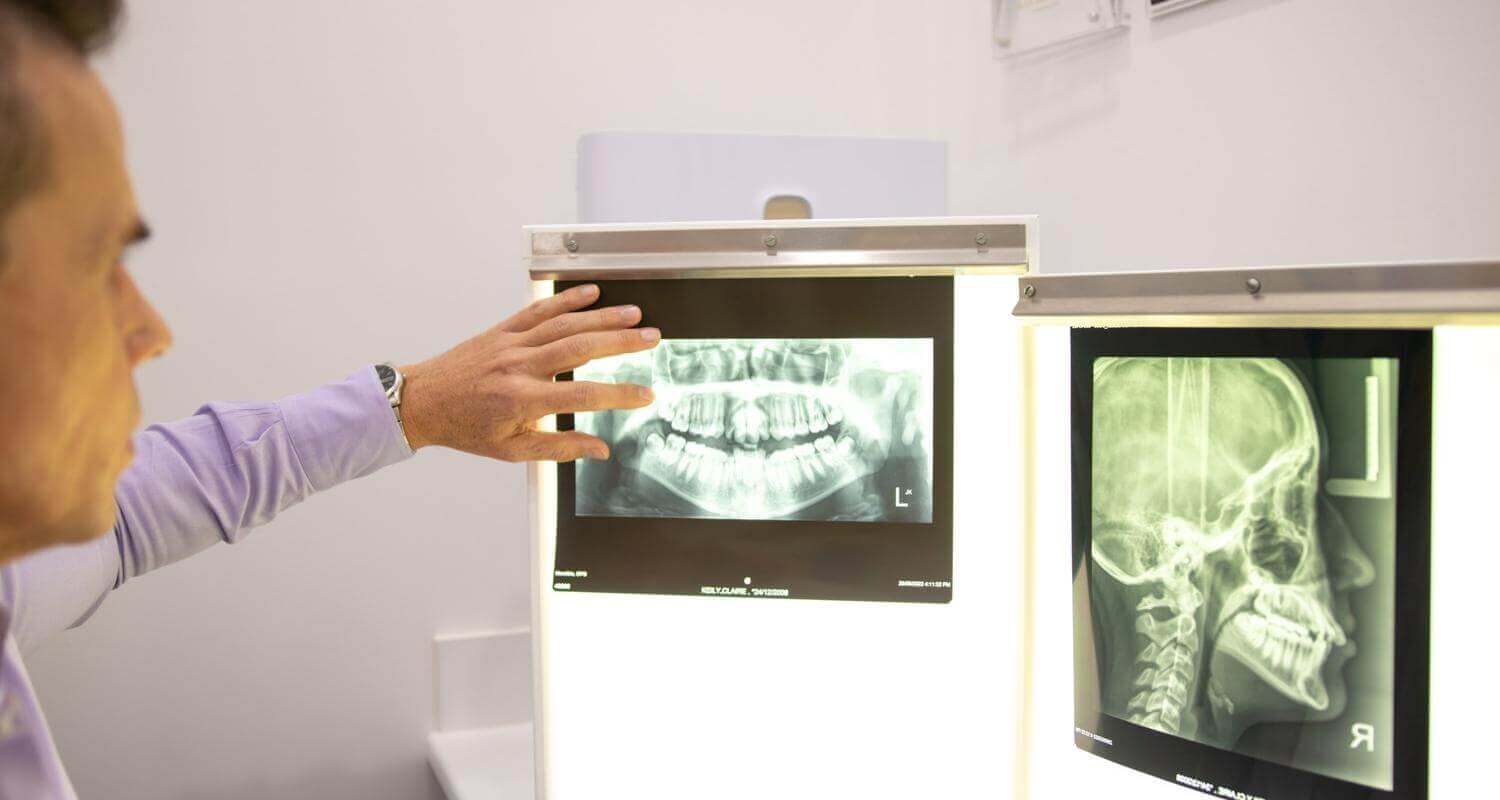 Are My Wisdom Teeth Going to Affect My Orthodontic Treatment
