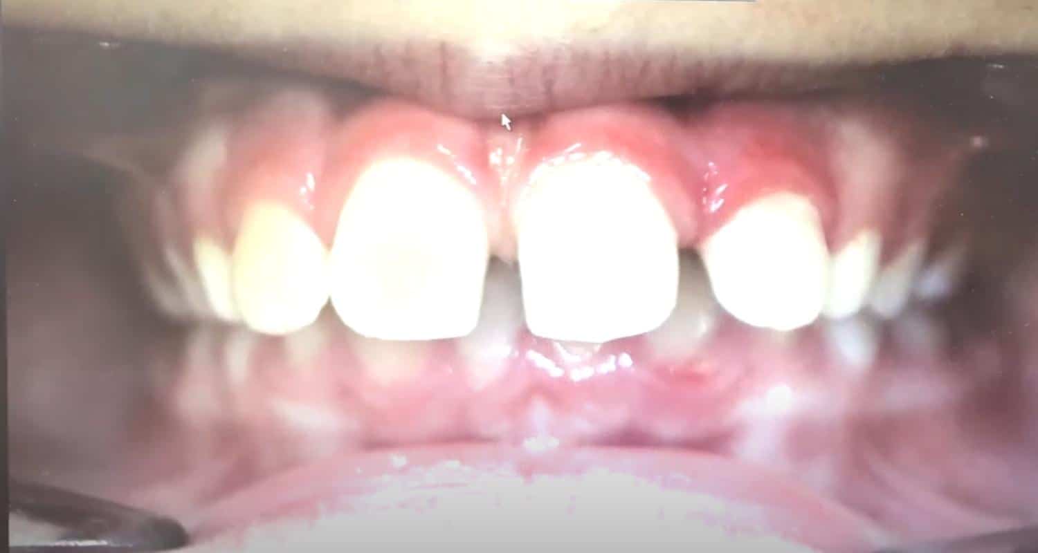 Using Clear Aligners for Children and Teens