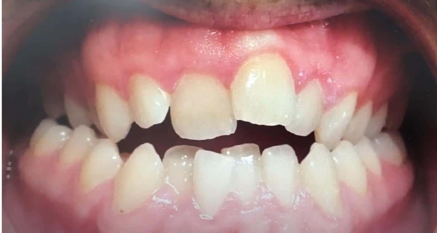 Common Questions About Clear Aligners