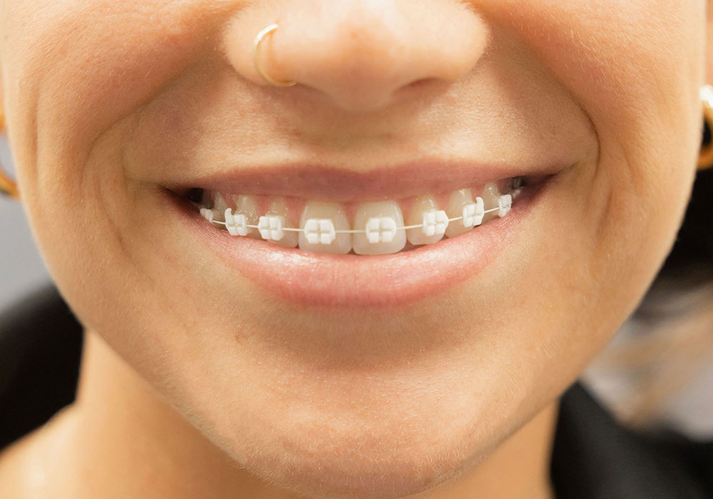 What Makes LightForce Braces Different From Regular Braces?