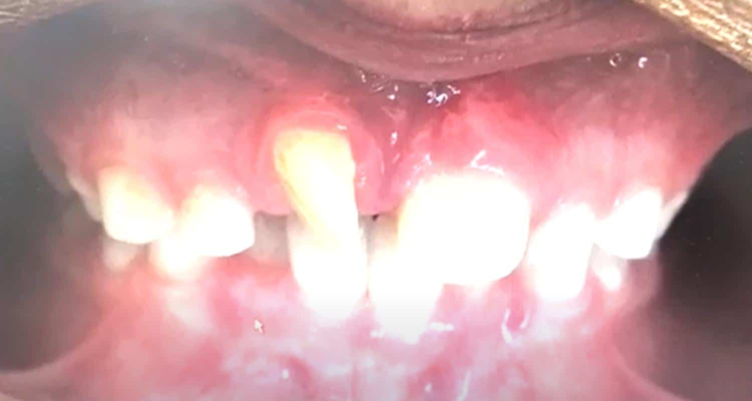 Using Clear Aligners for Children and Teens