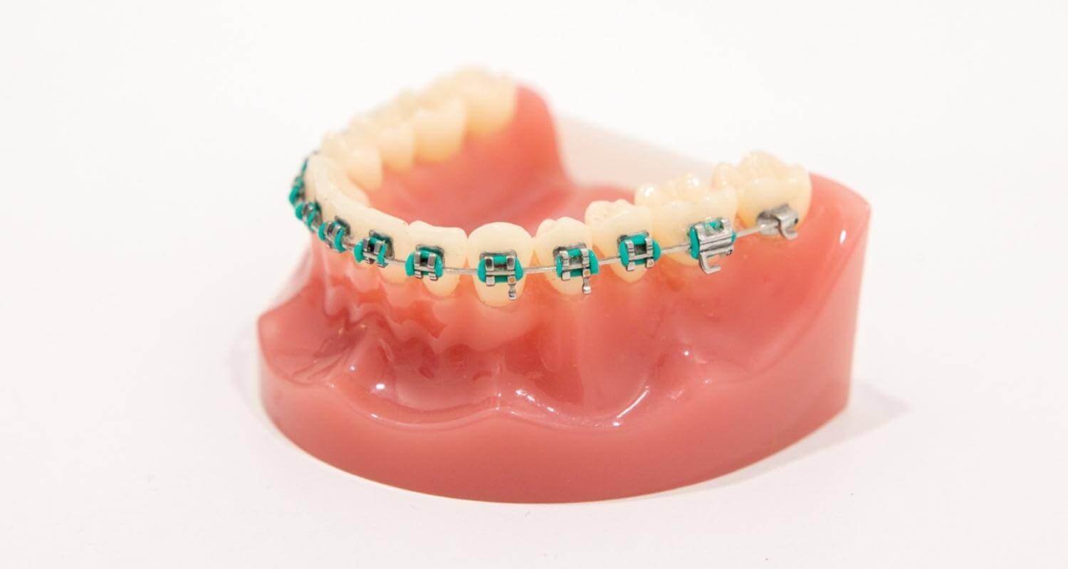 What Are the Different Types of Braces and the Pros and Cons of Each One?