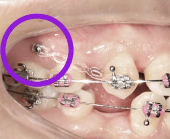 Recent Advancements in Mini Screws for Braces