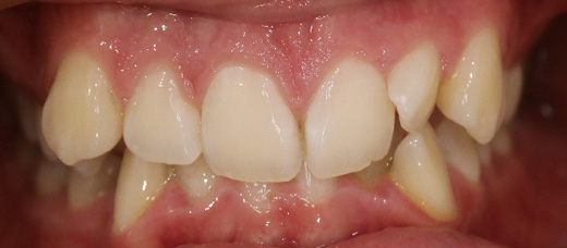 Teath Before