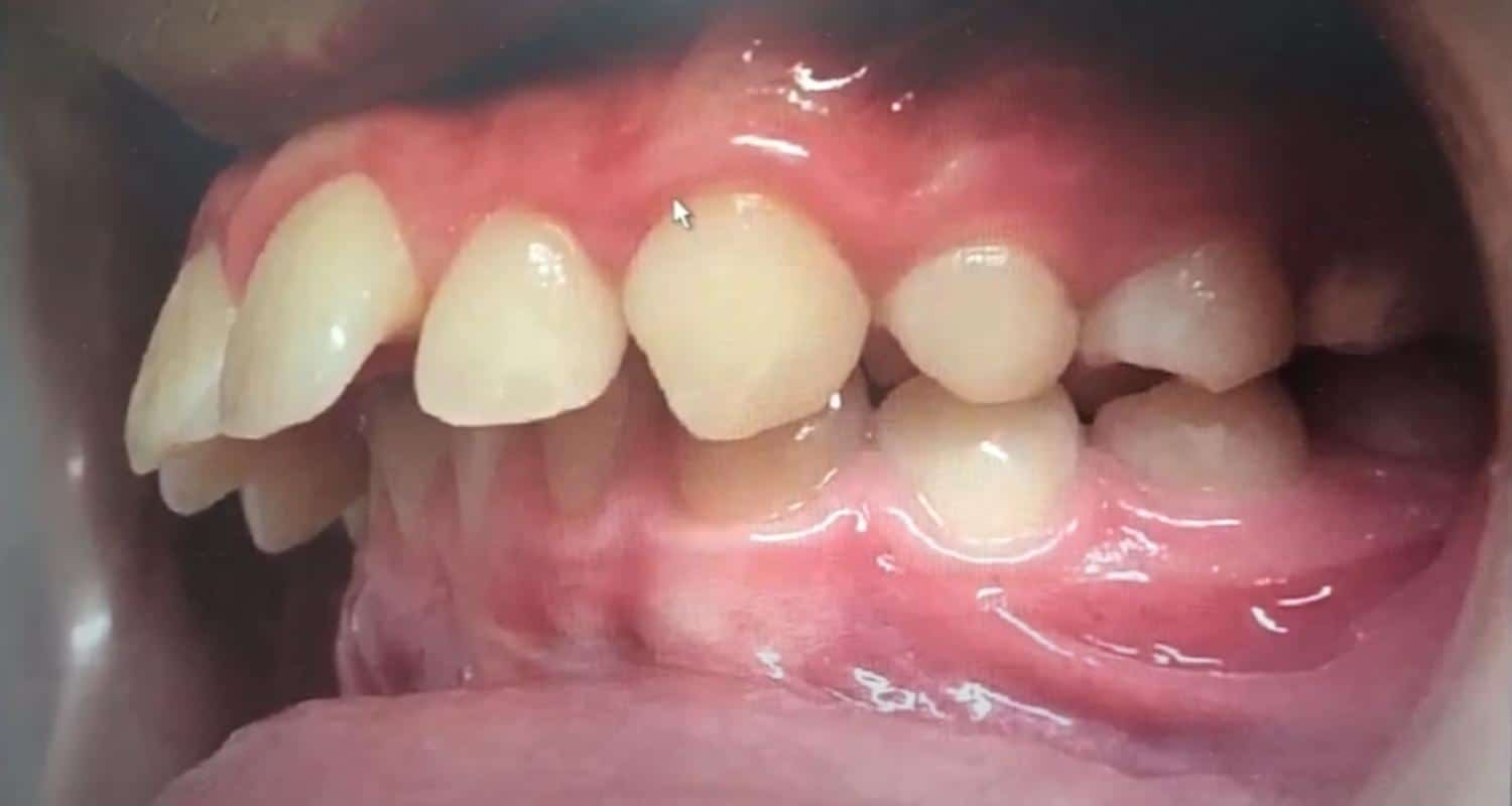 Common Questions About Clear Aligners