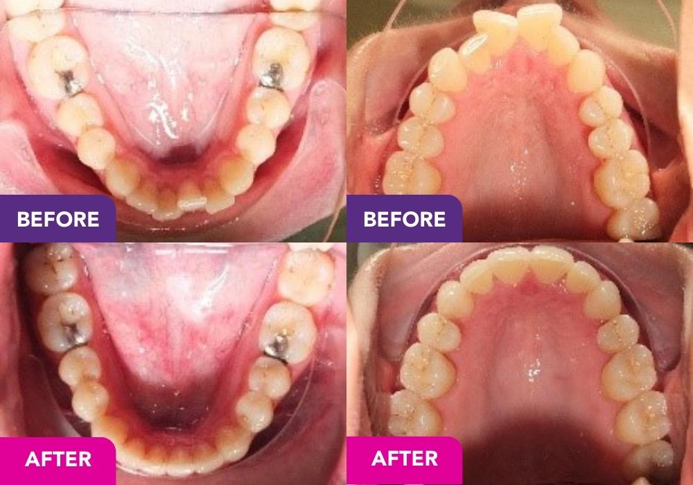 Adult-Orthodontics-Brisbane-Fortitude-Valley-Albany-Creek-Allstar-Orthodontics.jpeg