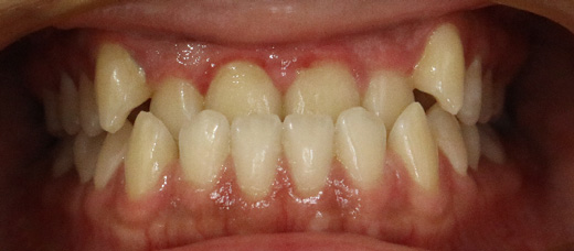 Teath Before