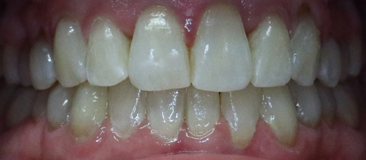 Teath After